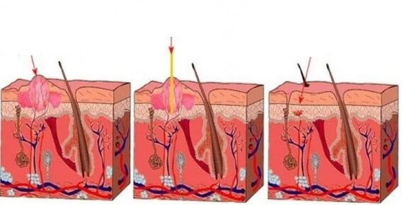 كيف يؤثر الليزر على الأورام الحليمية